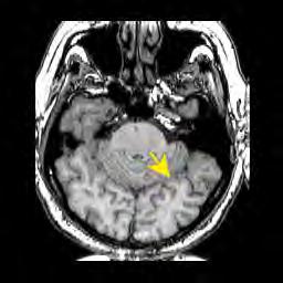 Gyrus