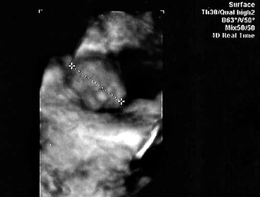 mózgowej w pierwszym trymestrze ciąży opis