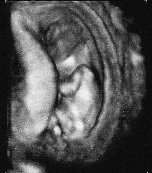 Dyskusja Rozpoznanie przepukliny mózgowej podczas badania ultrasonograficznego wykonywanego w pierwszym trymestrze ciąży jest możliwe już od końca lat 80-tych ubiegłego stulecia, kiedy to w 1988 roku