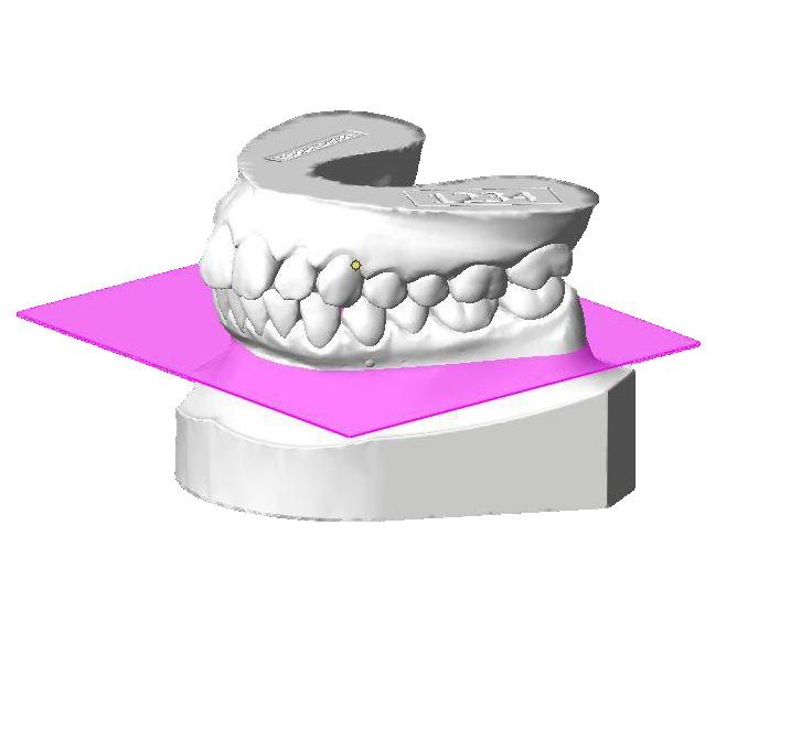 31 90000 Clear Aligner Opatentowany system przesuwania zębów i leczenia wad zgryzu PŁYTKI DO TERMOFORMOWANIA Do zastosowania w