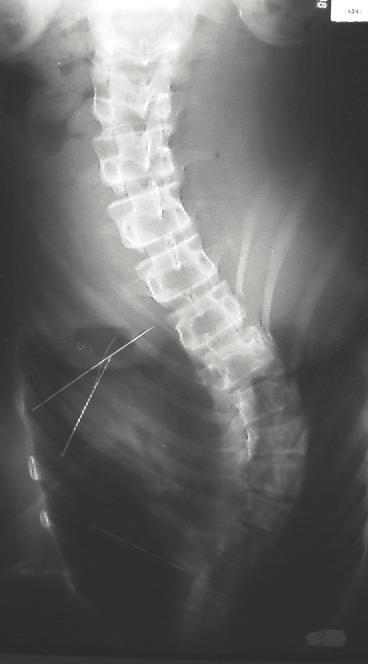 gęstość tkankikostnejzwiększasiętakżepo spondylodezachz zastosowaniemautogennychprzeszczepówkostnych.