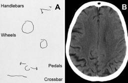 Posterior cortical atrophy (PCA) Tylna lub wzrokowa postać