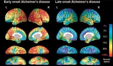 Grey matter loss of EOAD and LOAD patients compared with controls.