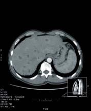 Rycina 2A. Obraz tomografii komputerowej klatki piersiowej chorego z przerzutowym rakiem oskrzelowo-pęcherzykowym.