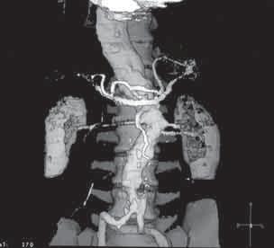 CT scan showing a forward displacement of the right kidney and infiltration of the retroperitoneal space by the pathological mass of the haematoma Rycina 3.