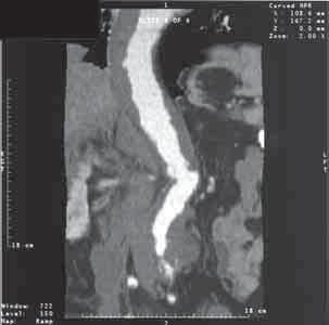 Rekonstrukcja morfologii tętniaka piersiowo-brzusznego na podstawie angiograficznego badania tomografii komputerowej Figure 2.
