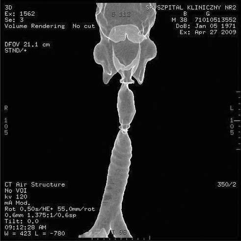 Diagnostyka zwężeń krtaniowo-tchawiczych z wykorzystaniem metod endoskopowych i tomografii komputerowej z rekonstrukcją 3D A B Ryc. 2A B. Chory G.B., lat 38; ok.