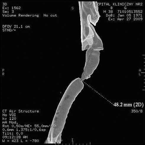 Zwężenie widoczne na długości minimum 10 12 mm u 12 i 30 chorych korelację pomiędzy SWTK 3D a endoskopią. Punktem odniesienia był obraz śródoperacyjny.