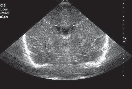 P R A C E O R Y G I N A L N E Ginekol Pol. 2014, 85, 933-938 Discussion s, corpus callosum lesions, sinus thrombosis and these children.