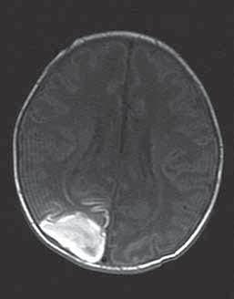 Thus, the earliest and the most common (Figure 1). Similarly, such early changes are reported in the known as the parasagittal cerebral injury or watershed injury in the remaining 2 cases.