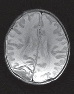 A Figure 2. A neonate with a diffuse bilateral white matter injury and supratentorial on the right side. A. SE/T1-weighted image shows hyperintense bleeding and hypointense signal from the damaged white matter.