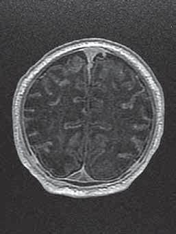 A neonate with acute asphyxia presenting as T1-hyperintensity in the basal ganglia (A) and diffusion restriction (B DWI sequence, C ADC map).