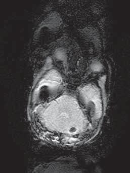 diffuse white matter injury, which was not present in the remaining newborns. Callosal injury Clinic).