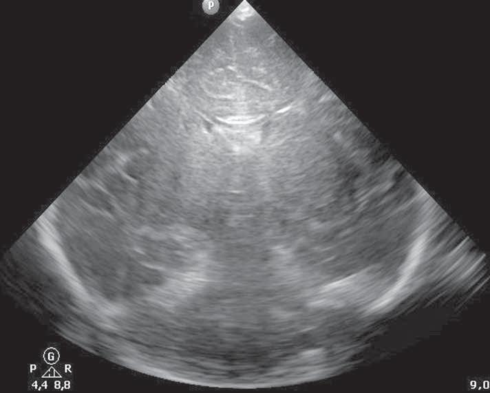 P R A C E O R Y G I N A L N E Ginekol Pol. 2014, 85, 933-938 Figure 5. US. Thalami with hyperechoic columns (coronal view). Figure 6. US. Color Doppler evaluation shows a high cerebral blood flow velocity with very low RI in ACA, RI-0.