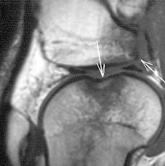 Act Clinic Ryc. 8,. Orz msywnego stæuczeni kæykci ocznych ko ci udowej i piszczelowej ze zæmniem wrstwy podchrzæstnej kæykci udowego. Przekroje strzækowe T1 () i FLASH ().