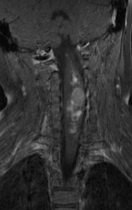 Gwiaździak (astrocytoma) Najczęściej występujący guz śródrdzeniowy u dzieci zmiana ekspansywna, nieostro odgraniczona, położona ekscentrycznie w T1 o niskiej do pośredniej intensywności sygnału w