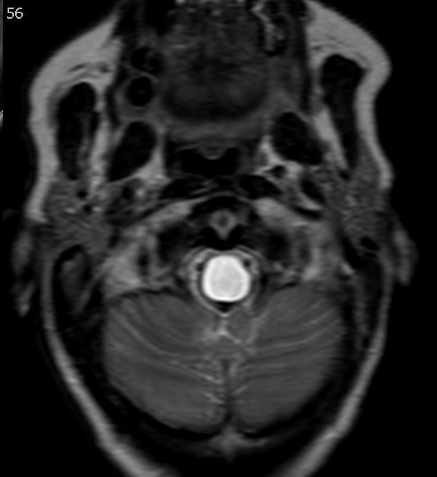 Pilocytic