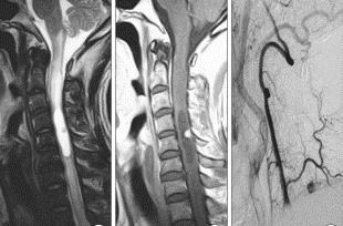 Naczyniak płodowy (haemangioblastoma) guz zlokalizowany powierzchownie w