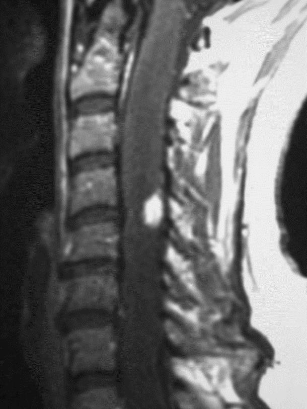 Haemangioblastoma