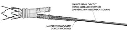 4 Przygotować system wprowadzania przedłużenia biodrowego w sposób opisany w części Przygotowanie systemu/systemów wprowadzania.