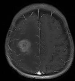 PCNSL Morfologia