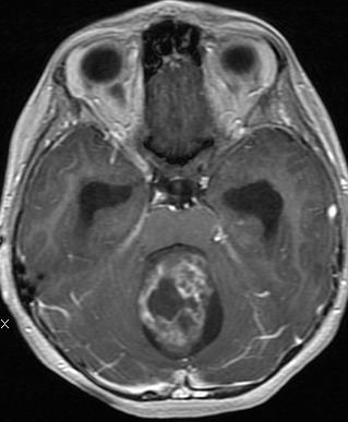 Astrocytoma