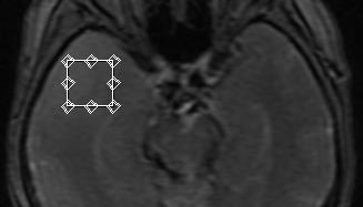 Astrocytoma fibryllare