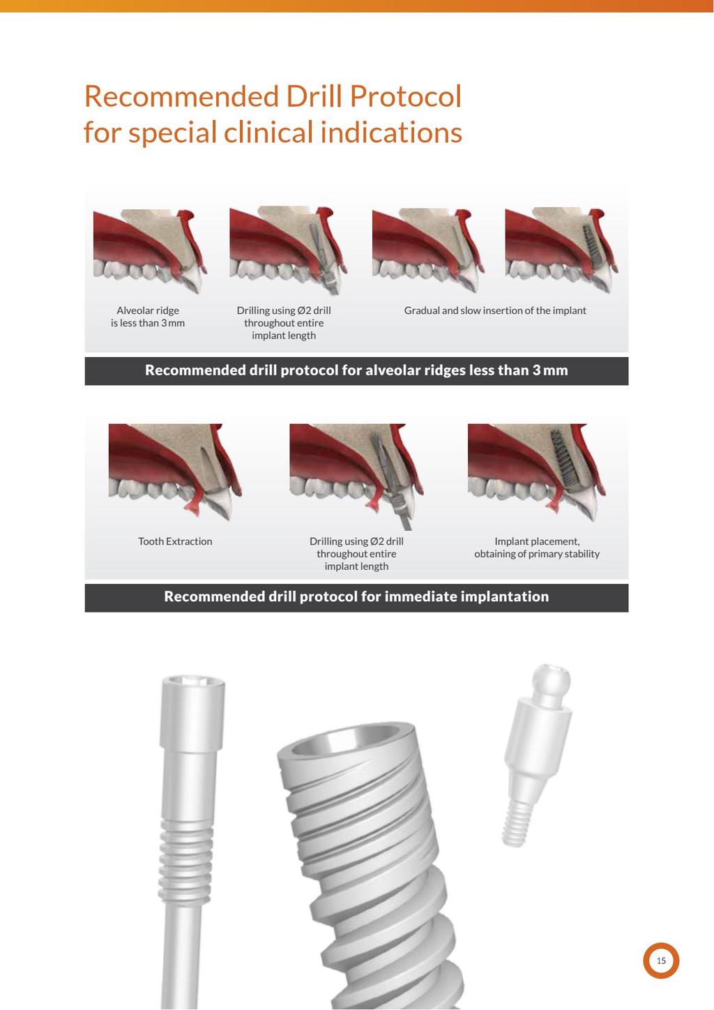 Zalecany Protokół Nawiercania dla specjalnych wskazań chirurgicznych Wyrostek zębodołowy węższy niż 3 mm Nawiercić przy użyciu wiertła ø 2 na całej długości implantu Stopniowe i powolne wprowadzenie