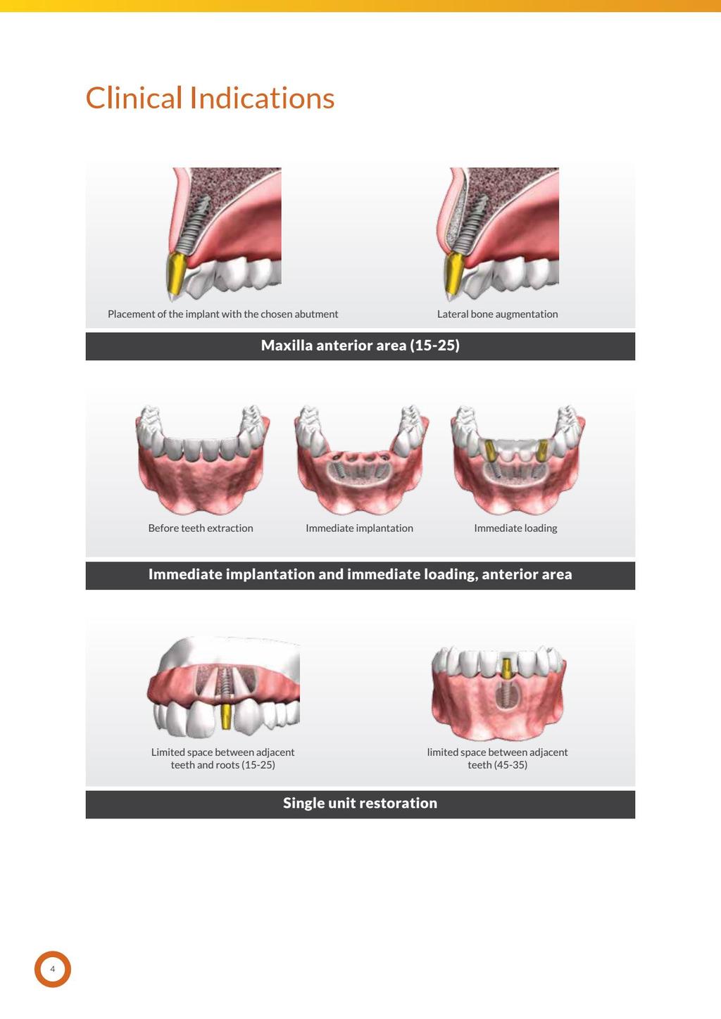 Wskazania Kliniczne Umieszczenie implantu z wybranym filarem / łącznikiem Boczna augmentacja kości.