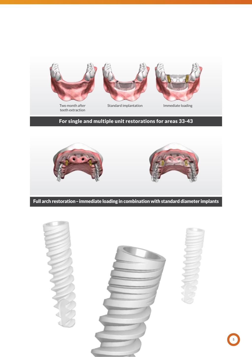 Dwa miesiące po ekstrakcji zębów Standardowa implantacja Natychmiastowe obciążenie Do jedno- i wielopunktowych odbudów dla pozycji 33-34 Odbudowa pełnego łuku natychmiastowe obciążenie w połączeniu z