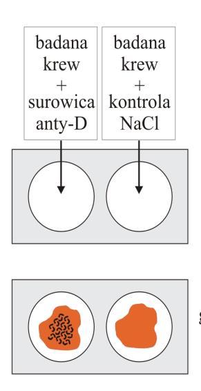 Do próbek krwi dodawano odpowiednie surowice (anty A, anty B oraz anty D). Wynik badania przedstawia rysunek. Określ grupę krwi w układzie ABO oraz obecność czynnika Rh u badanego.