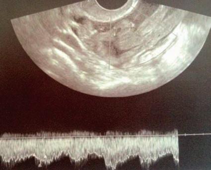 Color Doppler examination shows increased blood flow. According to IOTA, the ultrasound image presents a malignant adnexal tumor Ryc. 2.