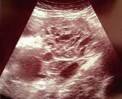 According to IOTA, the ultrasound image presents a non-malignant adnexal tumor traktowano jako niejednoznaczny, jeśli cechy M i B wystąpiły jednocześnie lub w ogóle nie wystąpiły (reguła 3.) (ryc.