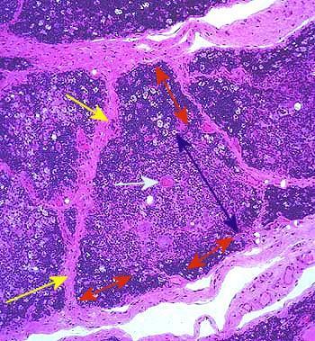 antygeny, jako obce (autoreaktywne limf. T). Mutacja genu aire choroby autoimmunologiczne.