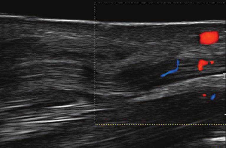 Berta Kowalska Ryc. 6. Obraz ultrasonograficzny nerwu pośrodkowego z cechami przekrwienia Fig. 6. Ultrasound image of the median nerve with hyperemia Ryc. 7.