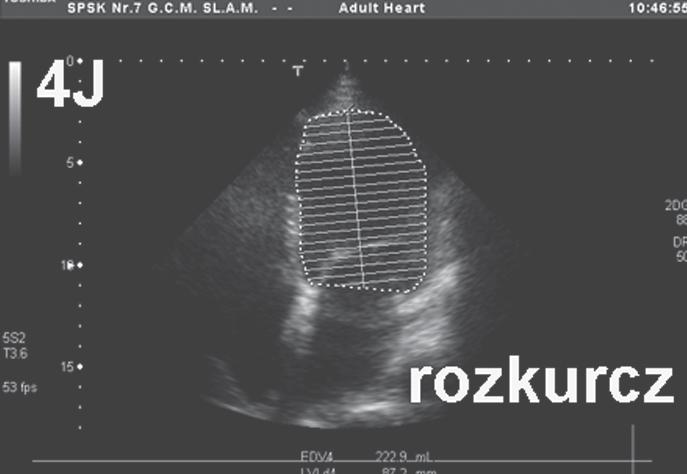 TAELA 2 Parametry echokardiografii doplerowskiej i napełniania komór Parametry doplerowskie Wzór Znaczenie Wskaźnik fali E/A Restrykcyjny (>2, krótki czas Wysokie ciśnienie napełniania, przeciążenie