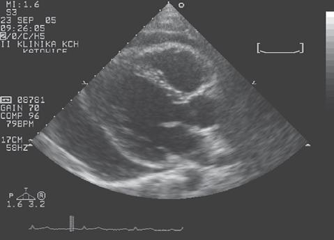 Obecnie pojęcie rozkurczowej niewydolności serca ustąpiło miejsca HF z zachowaną czynnością skurczową (HF with preserved ejection fraction, HFPEF). Stąd kluczowa rola echokardiografii.