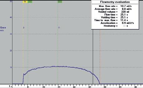 Magda Rakowska, Katarzyna Jobs, Grzegorz Paruszkiewicz, Anna Jung Ryc. 5. Zarys krzywej przepływu spłaszczony, ograniczone tempo Q max. Wynik nieprawidłowy przepływ cewkowy przeszkodowy Fig. 5. Plateau uroflow curve, limited Q max.