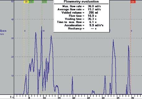 Examples of uroflowmetry interpretation taking into account testing circumstances Example 1 An 8-year-old girl, daytime urinary incontinence. Voiding journal: urine volumes from 130 to 180 ml (Figs.