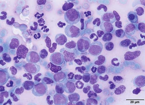Obraz ukazuje też praktycznie całkowite zastąpienie komórek hematopoezy przez komórki nowotworowe (białą strzałką oznaczono jedyną komórek hematopoezy, erytroblasta zasadochłonnego).