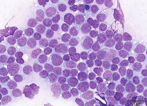 Ryc. 3. Obraz cytologiczny szpiku kostnego psa z ostrą białaczką niezróżnicowaną (AUL).