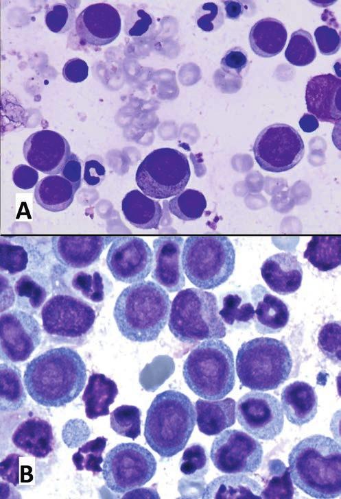 Ryc. 5. Obraz cytologiczny szpiku kostnego dwóch psów z ostrą białaczką mieloblastyczną (AML-M2). Część widocznych blastów wykazuje uziarninowanie cytoplazmy (szczególnie na rycinie B).