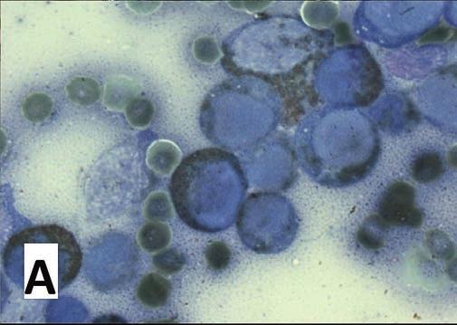 Ryc. 9. Przykłady barwień cytochemicznych stosowanych w rozpoznawaniu białaczek.