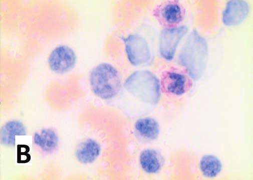 Na rycinie B widoczny wynik barwienia na obecność glikogenu różowe zabarwienie cytoplazmy neutrofilów; powiększenie 400 obecności antygenu CD34), jednak z uwagi na fakt że nie wszystkie blasty