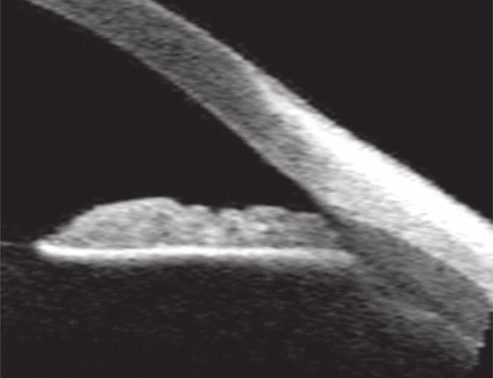 utrudniająca ogląd jego głębiej położonych struktur [7]. laserem argonowym (ALPI).