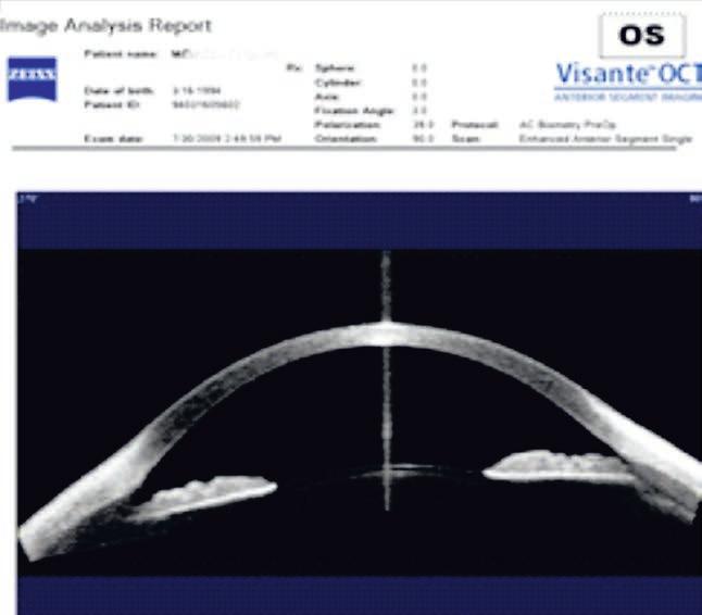 270 90 RYCINA 5 Obraz AS OCT Visante występująca w konfiguracji płaskiej tęczówki cysta wypełniona cieczą wodnistą. Cysta Efekt ten jest długotrwały.