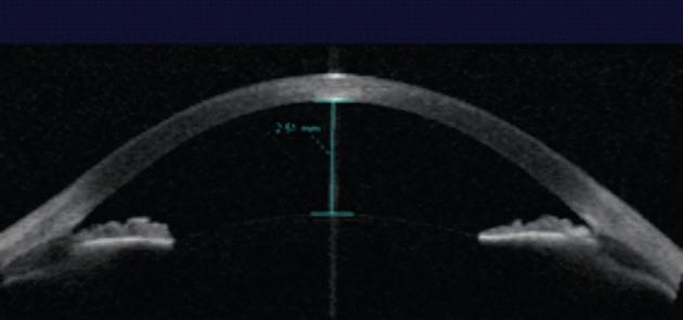 : oka prawego wynosiło 15,0 mmhg, oka lewego 14,0 mmhg.