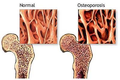 Osteoporoza