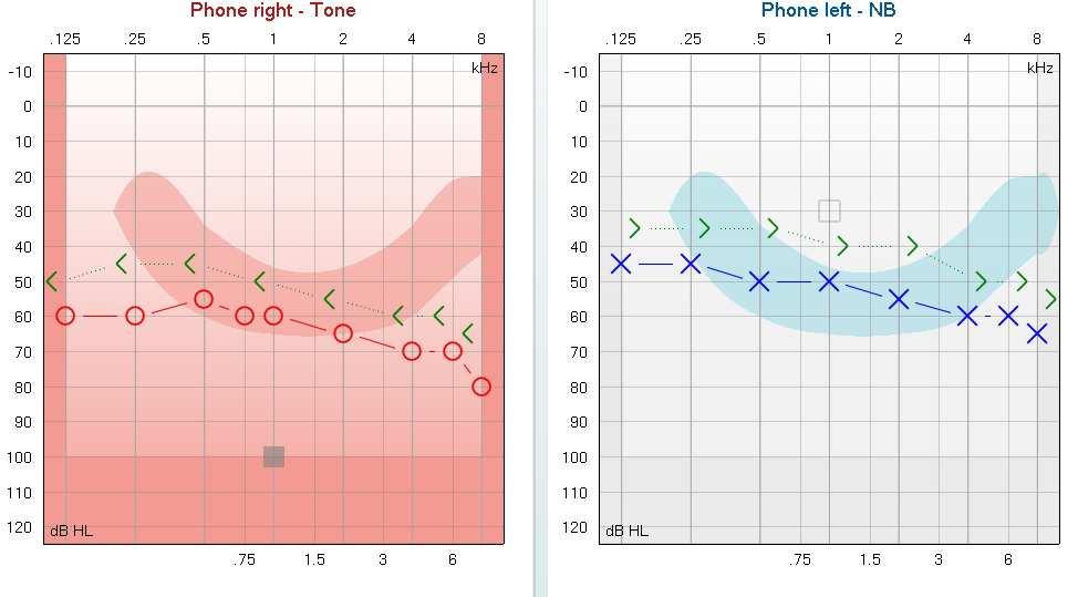 NIEDOSŁUCH ODBIORCZY Obie krzywe poniżej normy Nie ma rezerwy (droga powietrzna i kostna