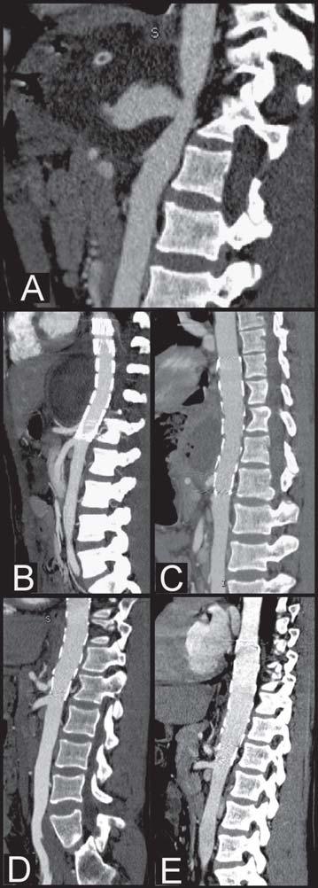 Endovascular treatment of abdominal aortic pseudoaneurysm, Solonynko et al. Figure 1. Angio CT-2D reconstructions: A. Before the operation, pseudo aneurysm with contract medium extravasation; B.